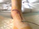 Ma jambe après le roc d'azur(fracture tibia/peroné)